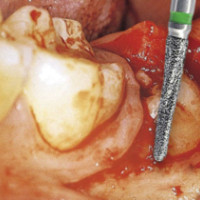 Kostné frézy Kostné frézy