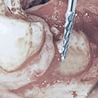 Separácia koreňov Separácia koreňov