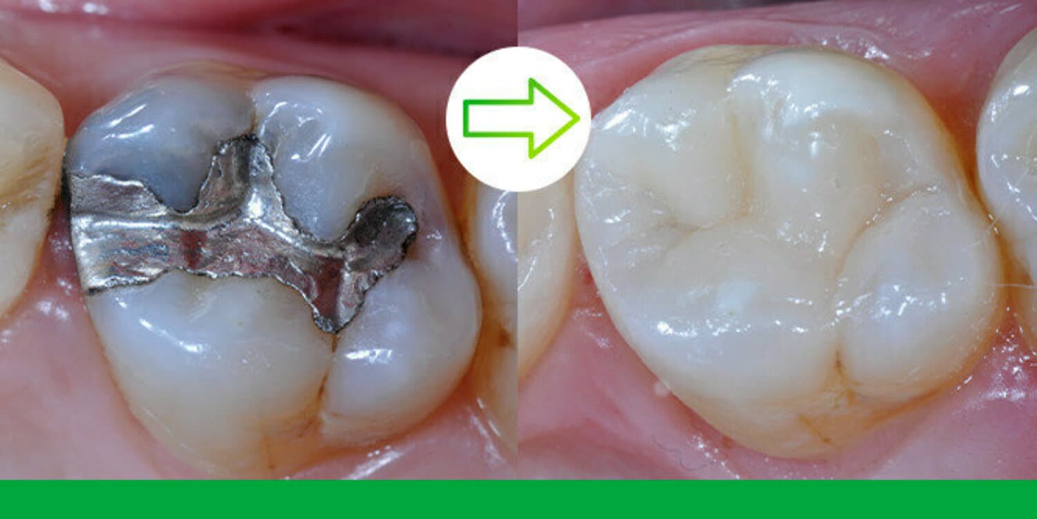 Shorter procedure. Superior strength. Better aesthetic: Treatment of fractured composite restoration of ﬁrst lower molar with 3M Filtek One Bulk Fill Restorative. Photos courtesy of Dr. Guiseppe Chiodera