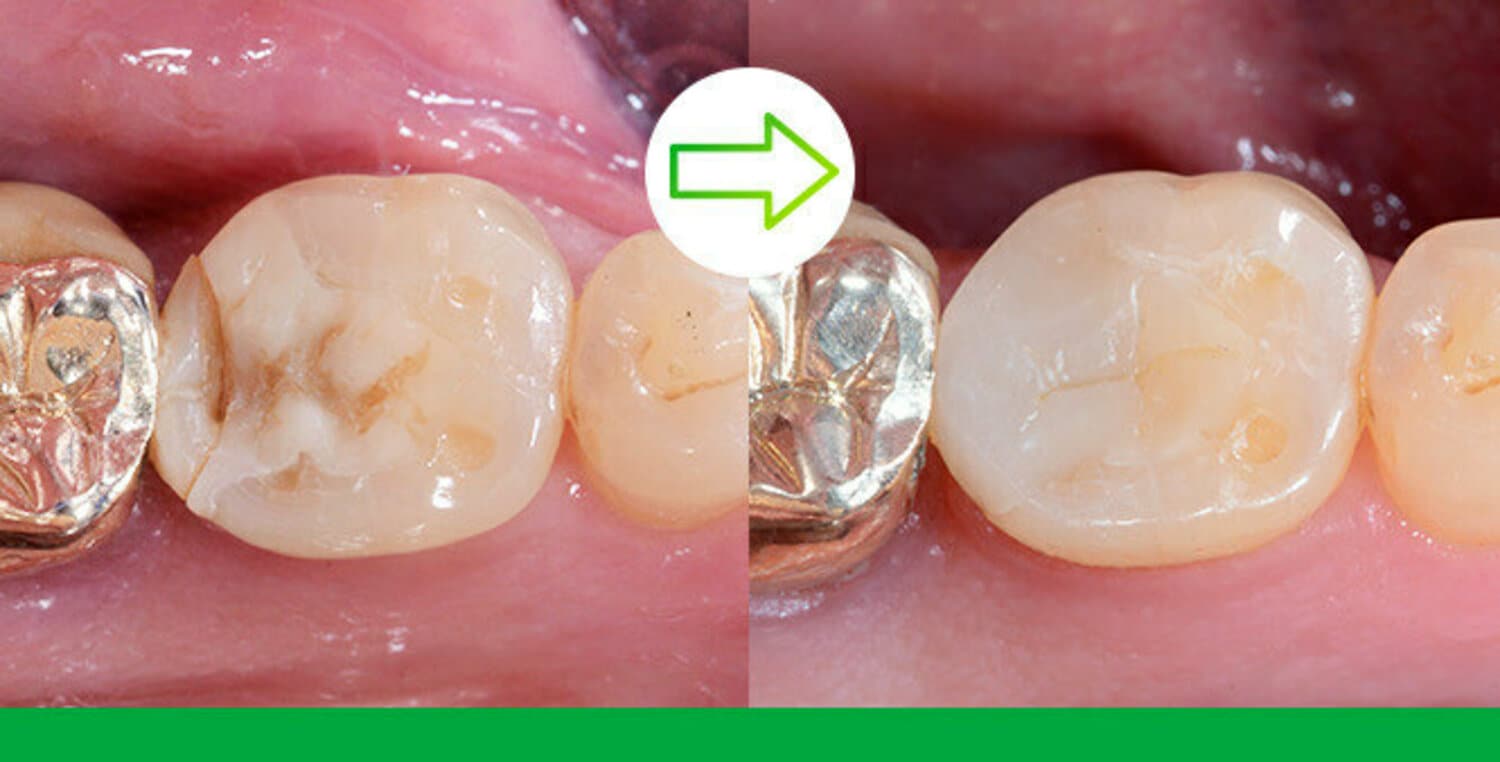 The exceptional adaptation of Filtek One Bulk Fill in action: Treatment of a deep carious lesion of second lower premolar with 3M Filtek One Bulk Fill Restorative. Photos courtesy of Dr. Filippo Dini