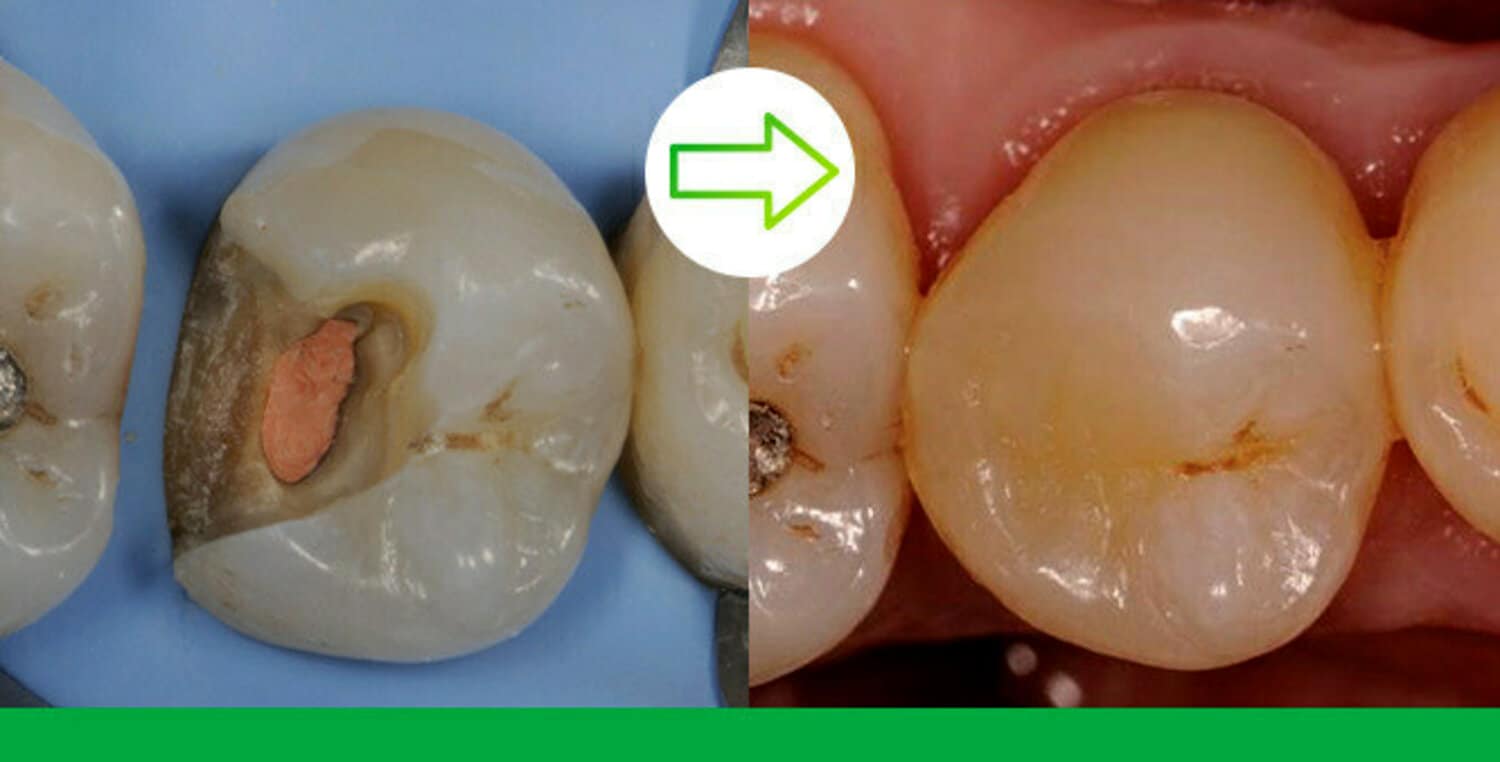 Sculpting natural-looking results: Direct restorations with 3M Filtek One Bulk Fill Restorative on upper premolar and molar due to primary and secondary caries. Photos courtesy of Dr. Giuseppe Marchetti