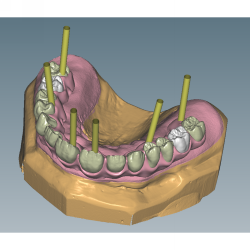 Ceramill M-Gin (upgrade Ceramill Mind)