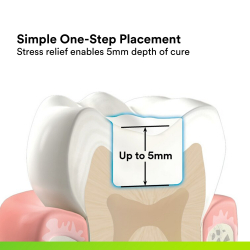 Vyplnenie v jednom kroku
Vaka mechanizmu uvoovania polymerizanho naptia je mon aplikova vrstvu a do 5 mm bez potreby vrstvenia