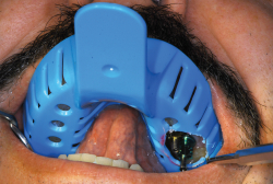 Miratray Implant  ukka pouitia